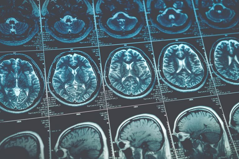 brain injury claim mistakes